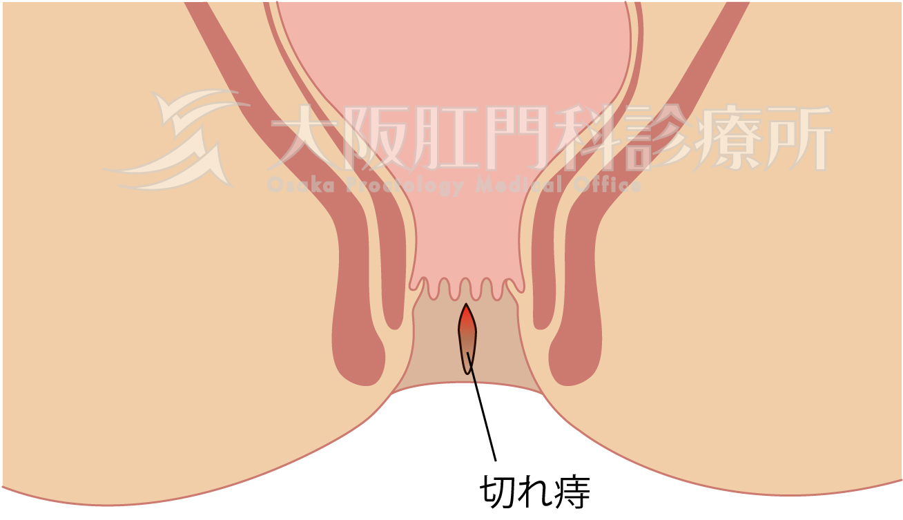 女性 肛門 画像