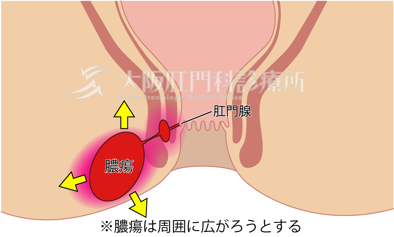 肛門周囲膿瘍 こうもんしゅういのうよう 大阪肛門科診療所 痔の入院 日帰り手術 女医の女性専用外来あり